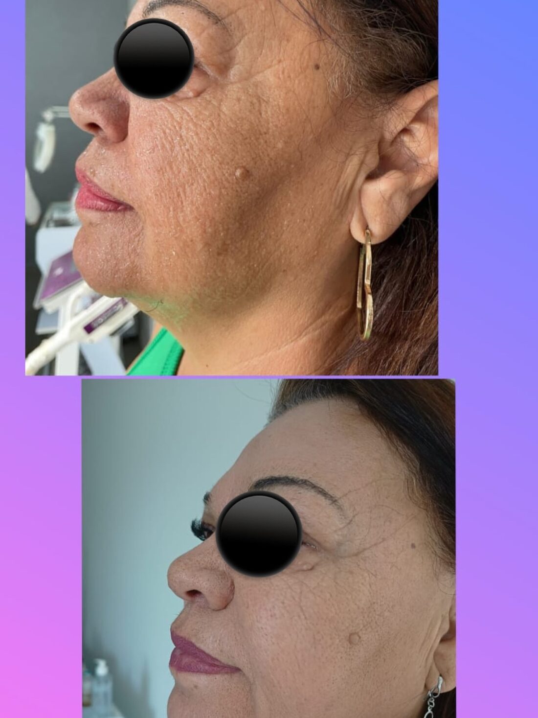 Pele antes do procedimento — cliente da Infinity Care
