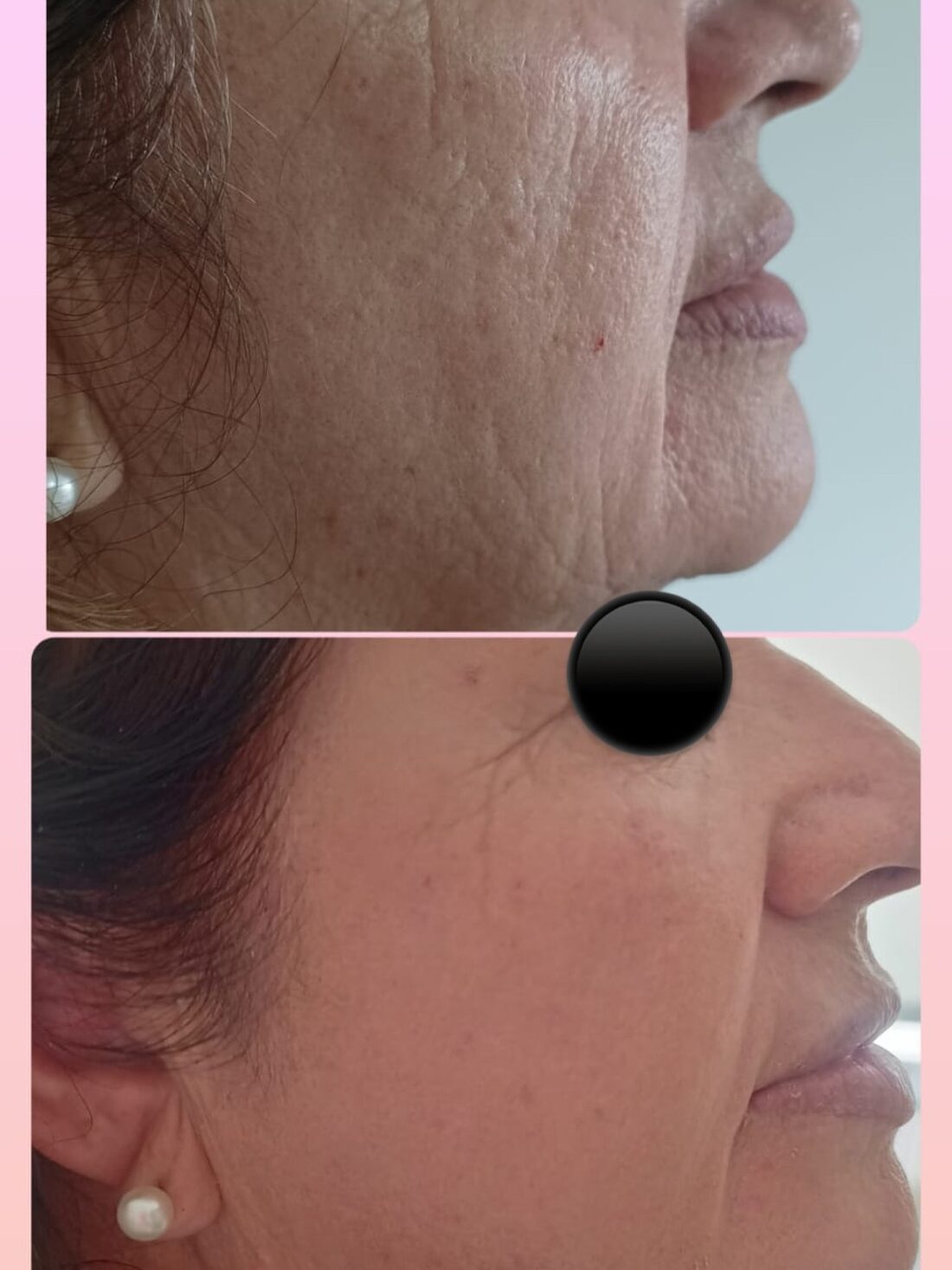 Pele após o protocolo — resultado real da Infinity Care