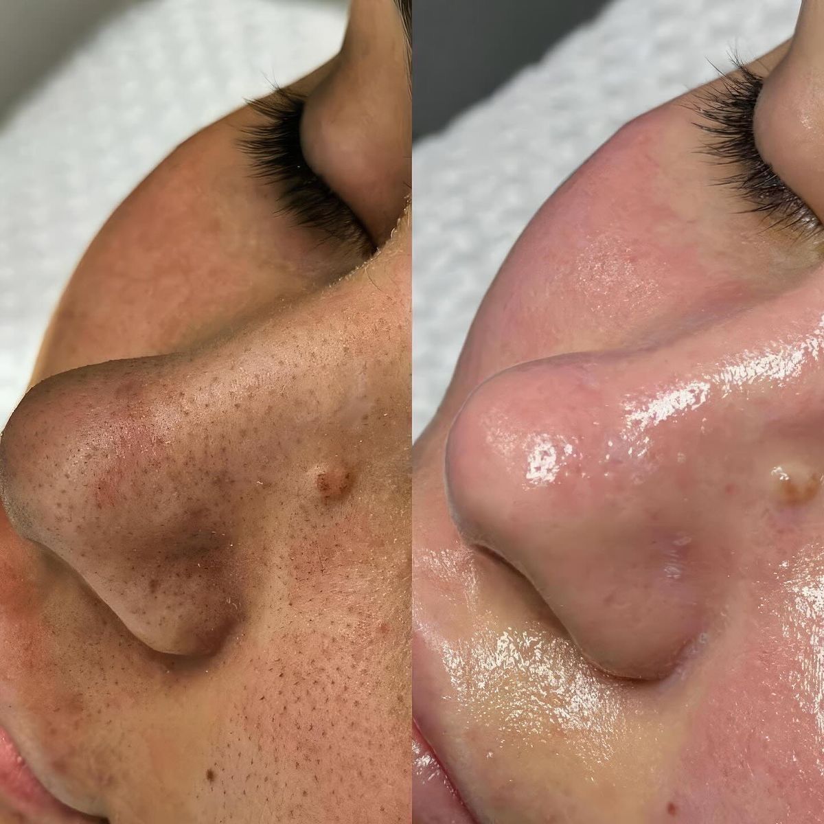 Resultado de procedimento facial